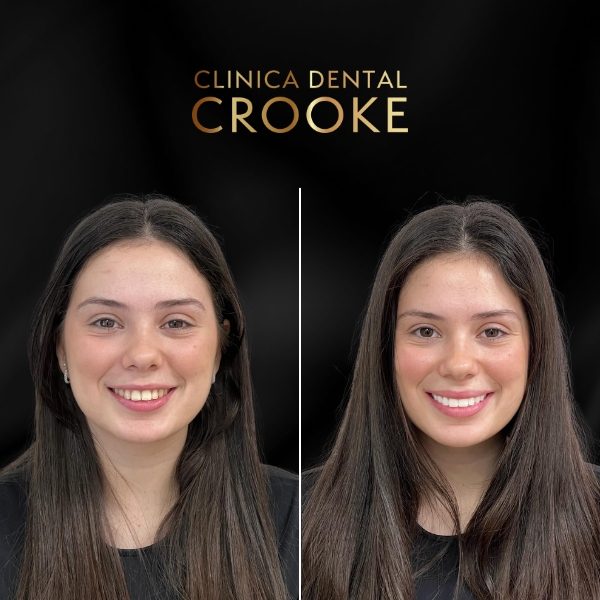 Antes y después del tratamiento, a la izquierda antes y a la derecha después: sonrisa del sector anterior tras el tratamiento estético